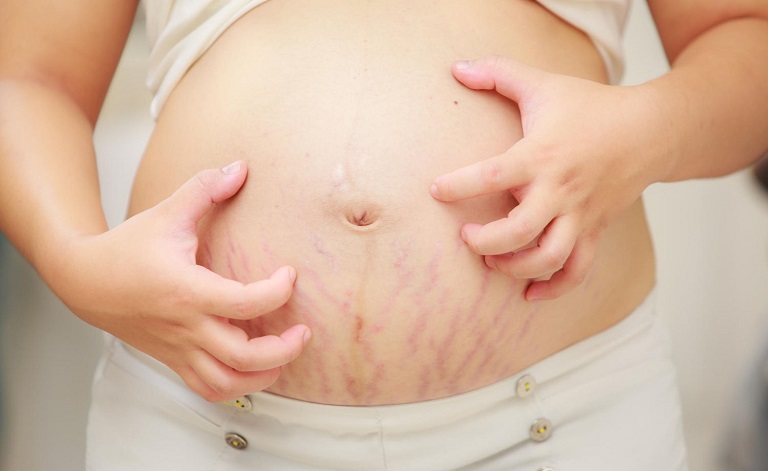 Nổi mề đay là bệnh thường gặp ở phụ nữ mang thai lần đầu