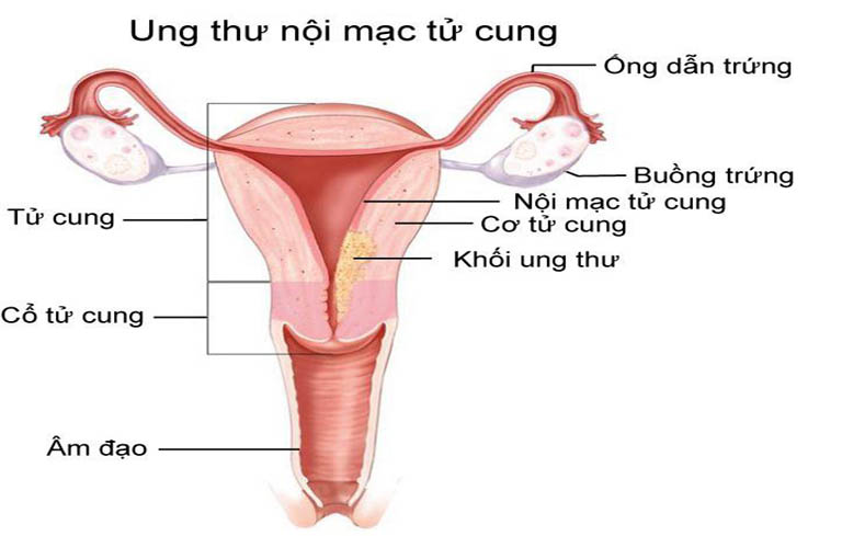 Viêm cổ tử cung có thể gây ung thư cổ tử cung