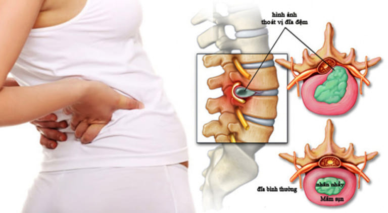 Thoát vị đĩa đệm ảnh hưởng nhiều đến sức khỏe của người mẹ trong giai đoạn thai kỳ