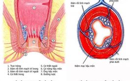 Tắc mạch trĩ nội xảy ra khi có cục máu đông hình thành trong búi trĩ