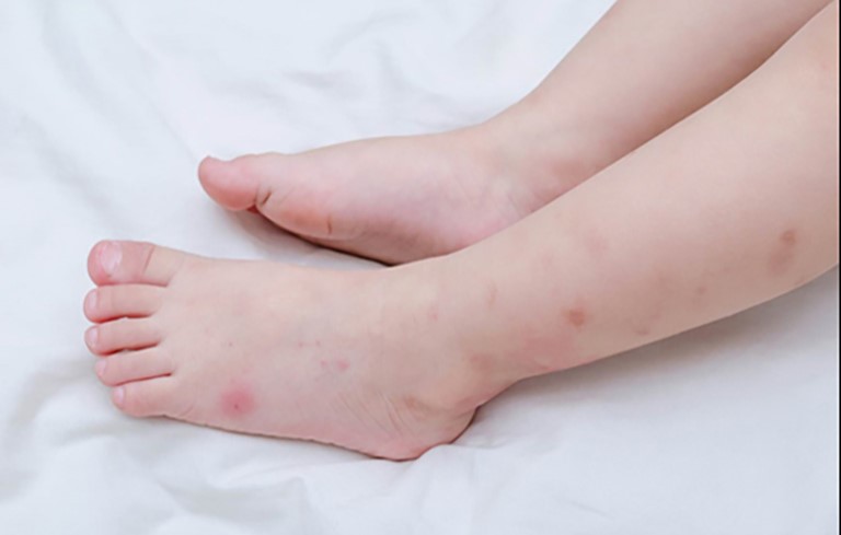 Hình ảnh bệnh viêm da tiếp xúc ở trẻ em 