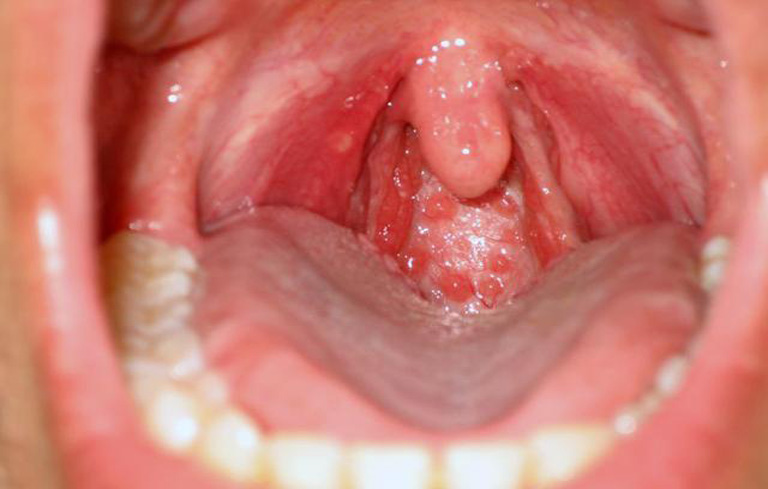 Viêm họng hạt là tình trạng niêm mạc họng bị viêm nhiễm nặng