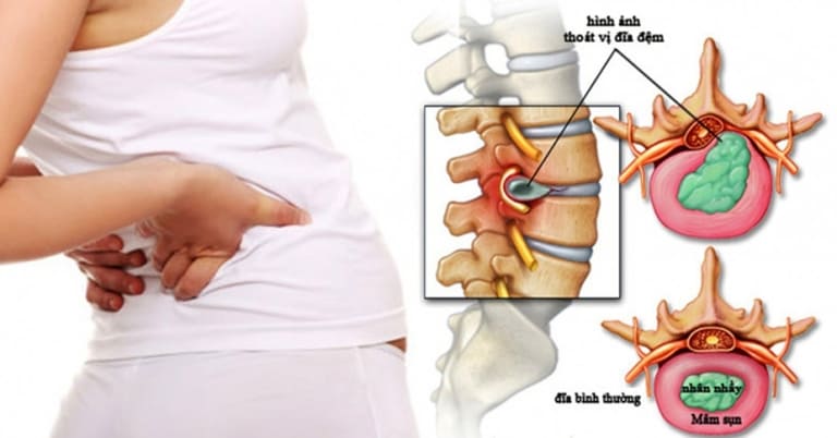 Thoát vị đĩa đệm cột sống thắt lưng có thể là một bệnh lý độc lập gây đau nhức từ mông đến chân. Đồng thời, nó cũng có thể là một trong những biểu hiện đầu tiên của tình trạng thoái hóa cột sống.
