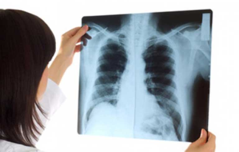 Chụp X-quang là cách xác định chính xác tình trạng bệnh