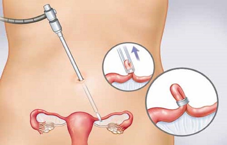 Chít hẹp cổ tử cung do làm thủ thuật điều trị bệnh lý khiến việc lưu thông máu khó khăn, gây đau bụng kinh