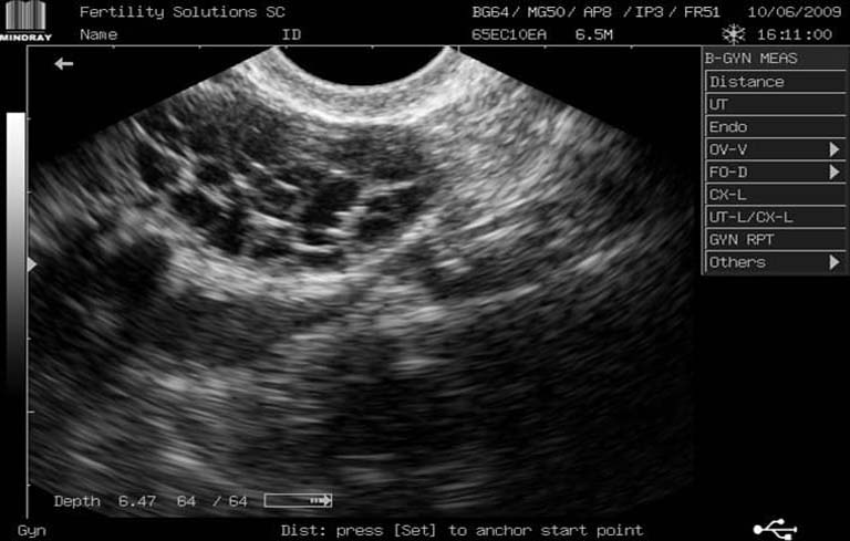Hình ảnh siêu âm buồng trứng đa nang có thể giúp bác sĩ chẩn đoán đúng bệnh