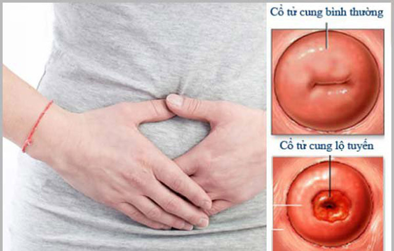 Dịch âm đạo màu xanh có thể là dấu hiệu cảnh báo viêm lộ tuyến cổ tử cung