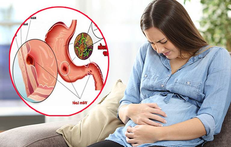 Đau dạ dày khi mang thai phải làm sao? Chuyên gia tư vấn cách điều trị
