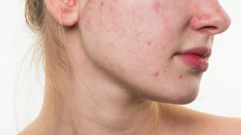 Mụn thường tập trung ở vùng da mặt, đặc biệt ở hai bên má