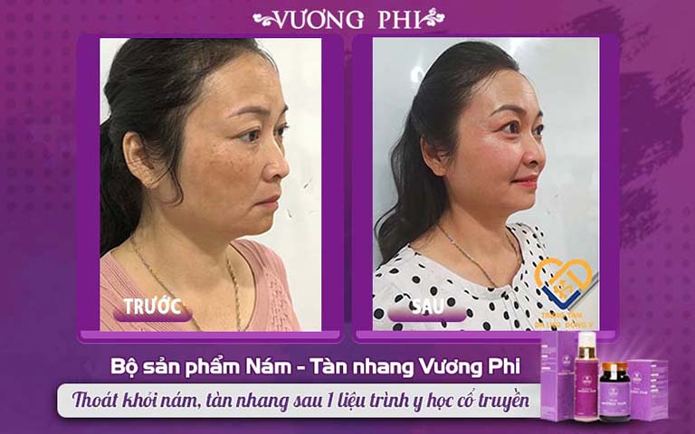 Làn da cô Hồng Vân cải thiện tới 80% khi mới sử dụng được 2/3 liệu trình thuốc