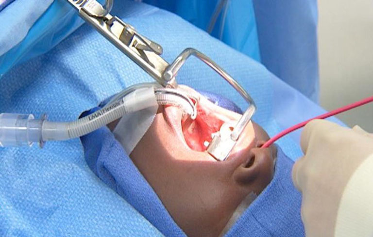 Phẫu thuật cắt amidan được chỉ định trong các trường hợp bệnh nặng