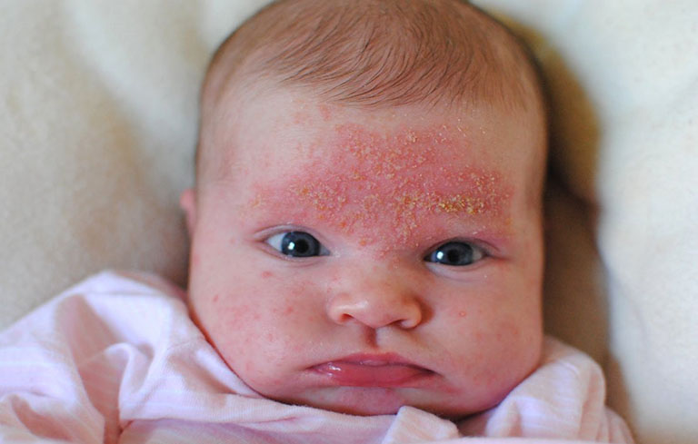 Hình ảnh viêm da cơ địa ở trẻ sơ sinh