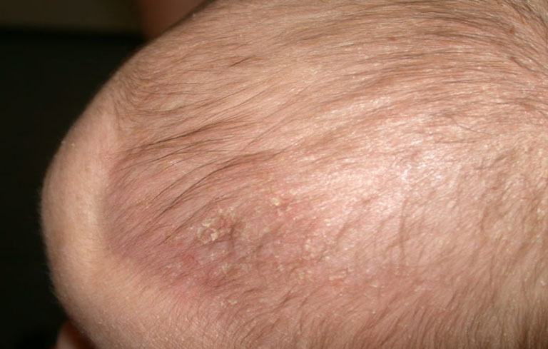 Viêm da tiết bã da đầu xuất hiện nhiều ở trẻ nhỏ