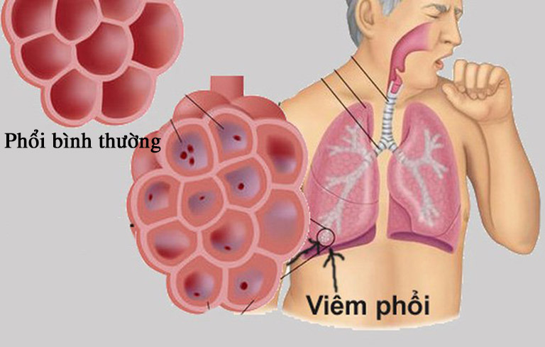 Viêm phế quản có thể tiến triển thành viêm phổi, gây khó khăn hơn điều trị