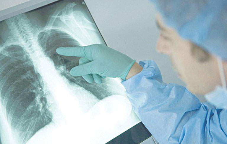 Dị vật vướng bên trong phổi làm tổn thương và cản trở đường thở của bệnh nhân