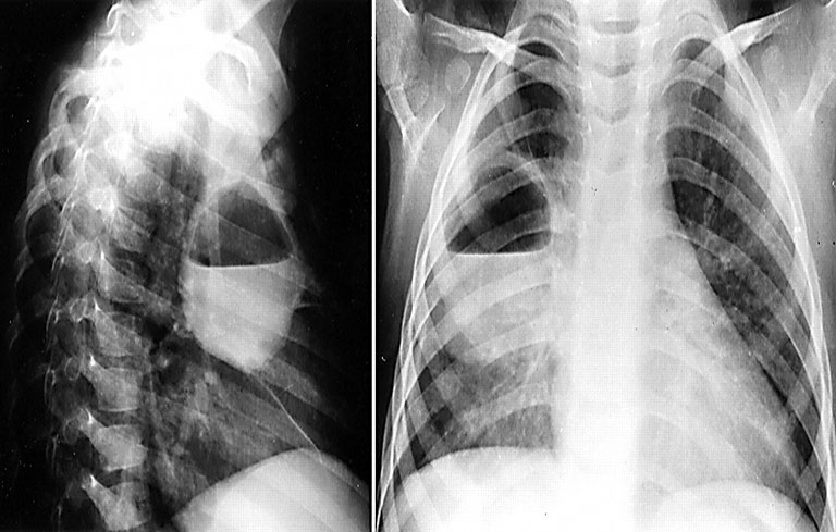 Bệnh nhân thường được chẩn đoán áp xe phổi thông qua hình chụp X-quang để thấy được chính xác những tổn thương đang xảy ra