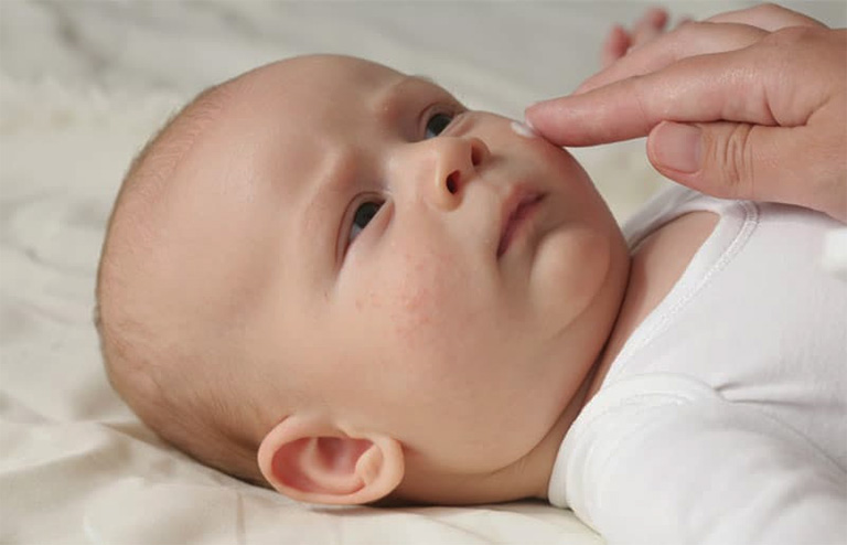 Trẻ bị chàm sữa nên bôi thuốc gì an toàn và không gây ra tình trạng kích ứng da