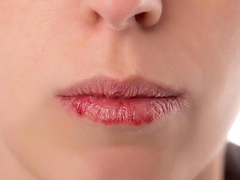 Bệnh chàm môi có lây không?