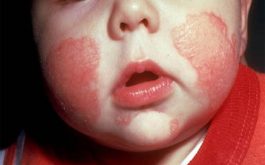 Bệnh chàm khô ở trẻ em