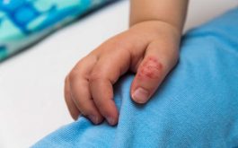 Bệnh tổ đỉa ở trẻ em - Dấu hiệu nhận biết và điều trị