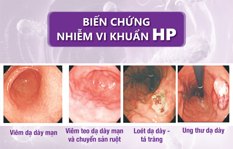 Viêm dạ dày HP gây nên 4 biến chứng nguy hiểm