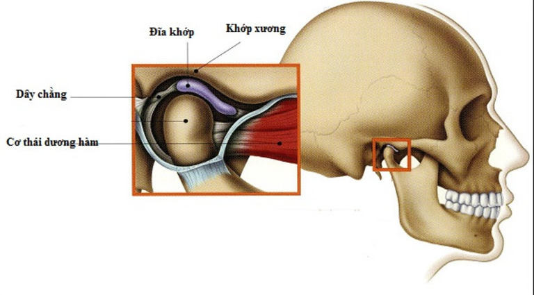 Giãn khớp hoặc nổi hạch đều là những biến chứng thường gặp. Nó có thể dẫn đến thủng đĩa khớp và khiến miệng không thể mở ra.