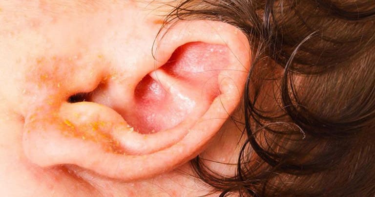 Bé sẽ cảm thấy rất ngứa ngáy khó chịu và có thể bị đau rát khi dịch nhầy trong các nốt mụn chảy khi khi bị chàm vành tai.