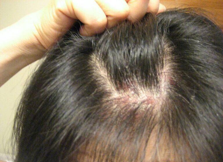 Nấm da đầu gây ngứa ngáy khó chịu và khiến một số vùng tóc bị mất đi.