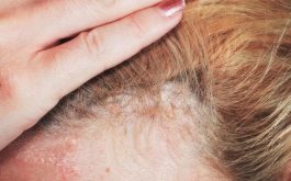 Các bệnh về da đầu thường gặp