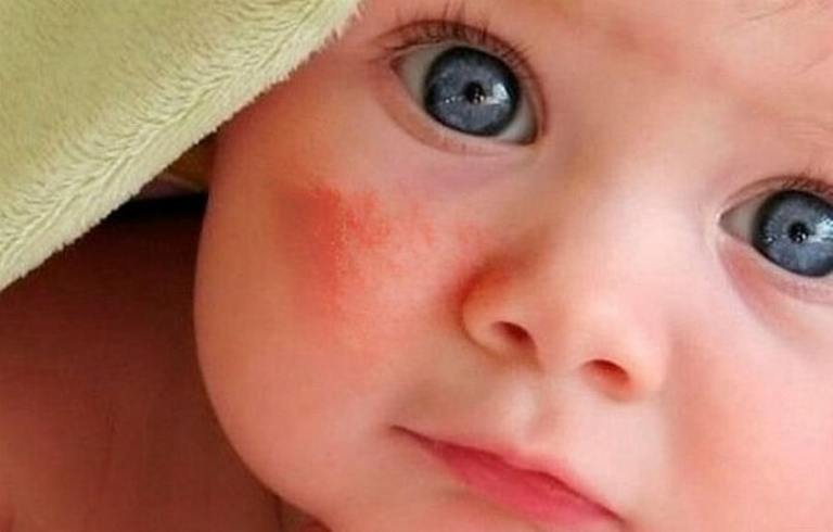 Chàm đỏ ở trẻ sơ sinh khiến bé rất khó chịu. Bệnh ảnh hưởng nhiều đến sự phát triển sau này của trẻ nếu không điều trị kịp thời và đúng cách.