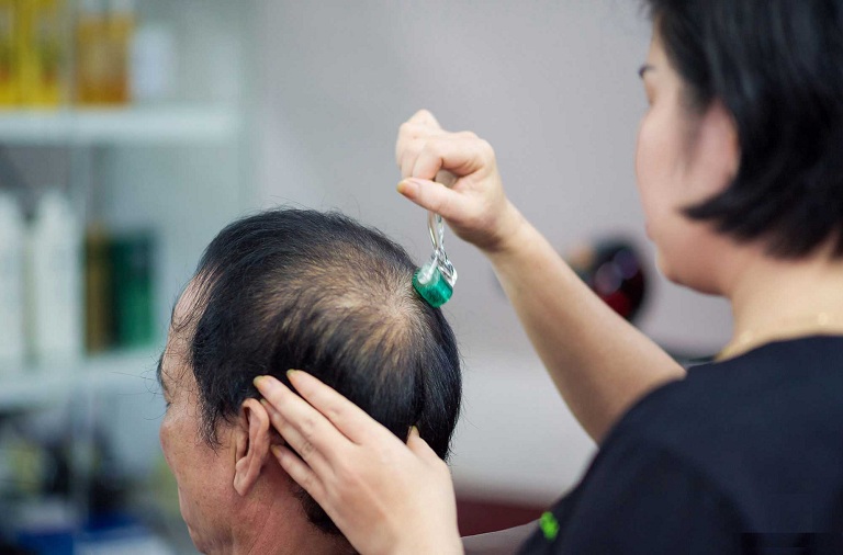Tham khảo một số bài thuốc Đông y trị rụng tóc hiệu quả 