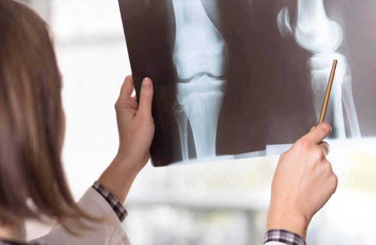 Chụp X -quang là kỹ thuật chẩn đoán bệnh viêm khớp gối tràn dịch cơ bản.