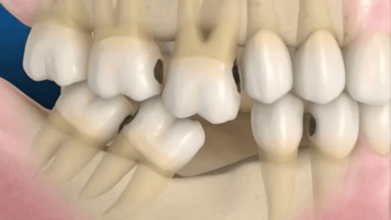 Cấu tạo của hàm răng có thể bị sai lệch cấu trúc khi bị viêm khớp thái dương hàm. Do đó, người bệnh có thể được nắn chỉnh để cải thiện đau nhức.