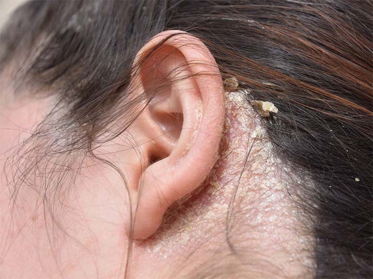 Bệnh nấm da đầu có thể dẫn đến sẹo, thậm chí là rụng tóc vĩnh viễn ở những trường hợp bị viêm hoặc nhiễm trùng nghiêm trọng