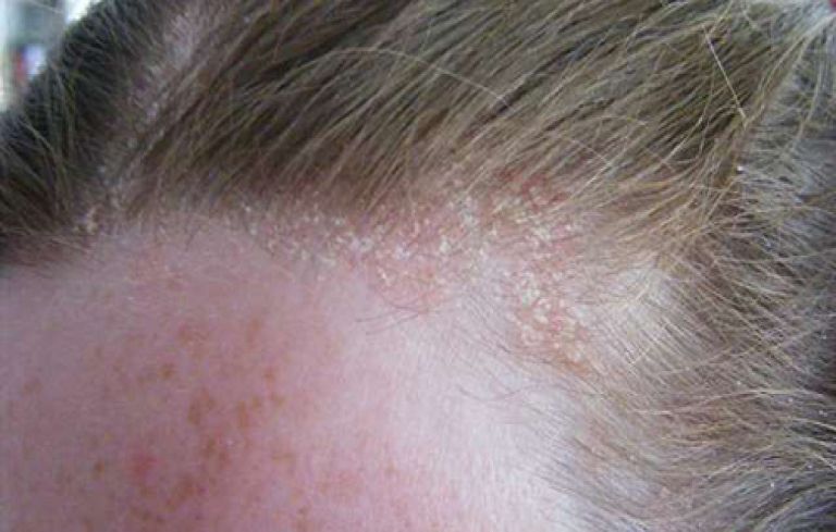 Hình ảnh bệnh vảy nến da đầu