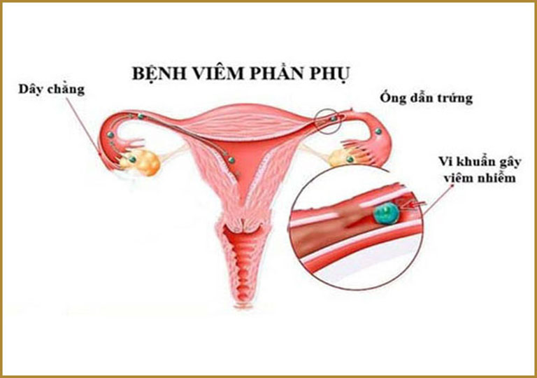 Viêm phần phụ ở phụ nữ mang thai là tình trạng viêm nhiễm các cơ quan sinh sản nữ như vòi trứng, buồng trứng, dây chằng 