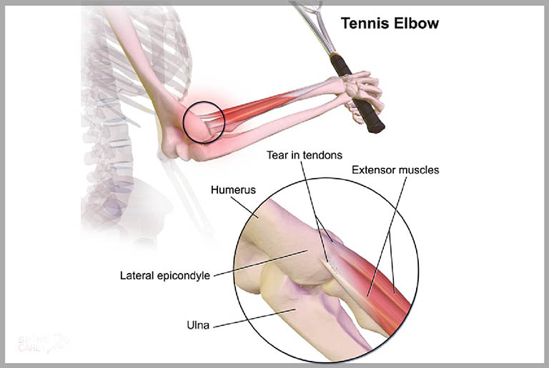 Hội chứng Tennis elbow