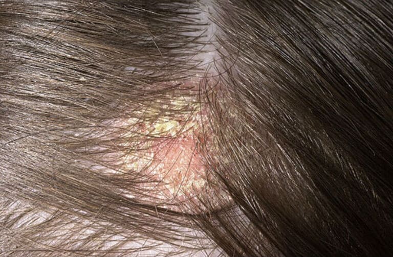 Nấm da đầu có thể gây nhiễm trùng máu nếu không được điều trị kịp thời và người bệnh không biết cách chăm sóc da.