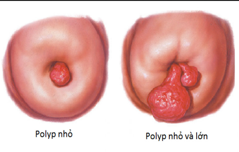 Polyp, chít hẹp cổ tử cung khiến những cơn đau bụng kinh trở nên khó chịu