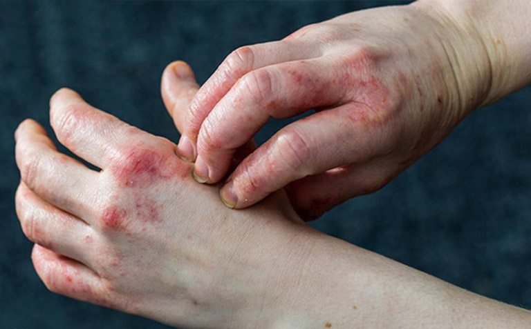 Không được dùng tay cào gãi lên da gây tổn thương, gia tăng nguy cơ nhiễm trùng