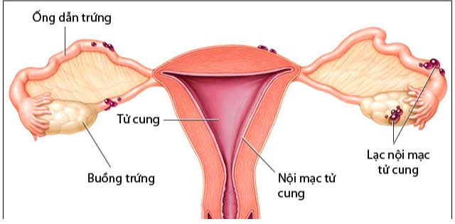 Lạc nội mạc tử cung nhẹ là nguyên nhân gây vô sinh khó có thể kiểm tra