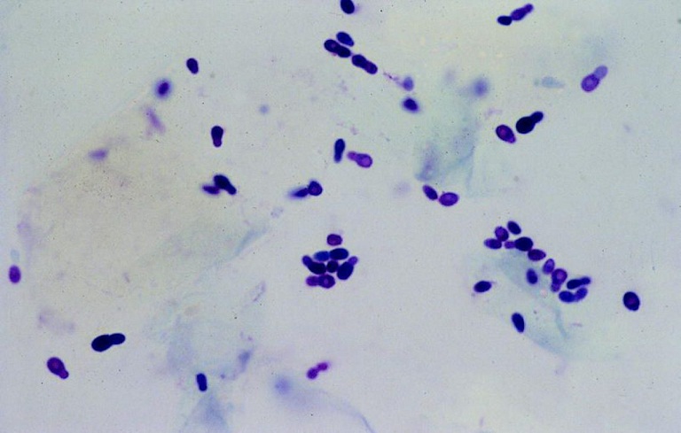 Hình ảnh vi nấm gây lang ben soi trên kính hiển vi