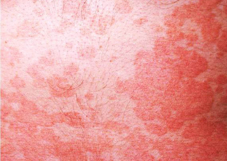 Lang ben đỏ hình thành nên các chấm hoặc mảng đỏ trên da gây mất thẩm mỹ
