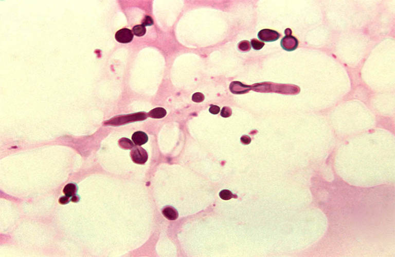 Bệnh lang ben hình thành ở lưng là do sự xâm nhập và sự tác động của nấm Pityrosporum orbiculaire