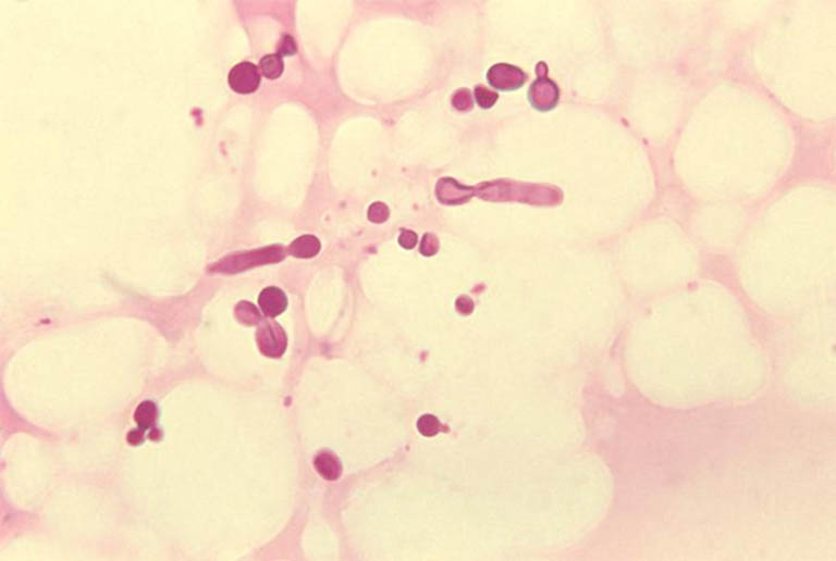 Bệnh lang ben ở trẻ sơ sinh hình thành và phát triển bởi sự xâm nhập của nấm malassezia