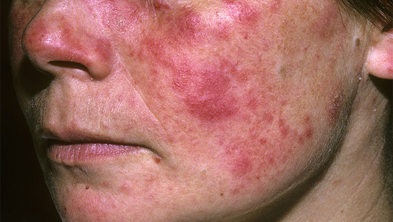 bệnh lupus ban đỏ hệ thống