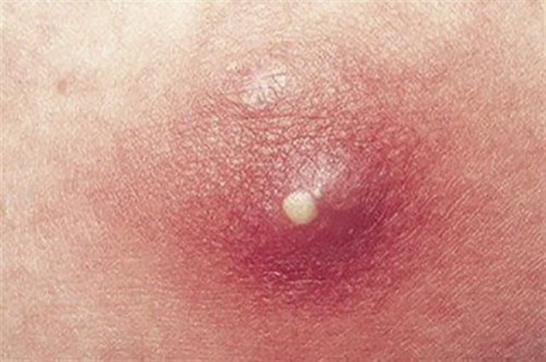 Mụn nhọt thường xuất hiện ở các nang lông bị nhiễm khuẩn gây đau nhức khó chịu