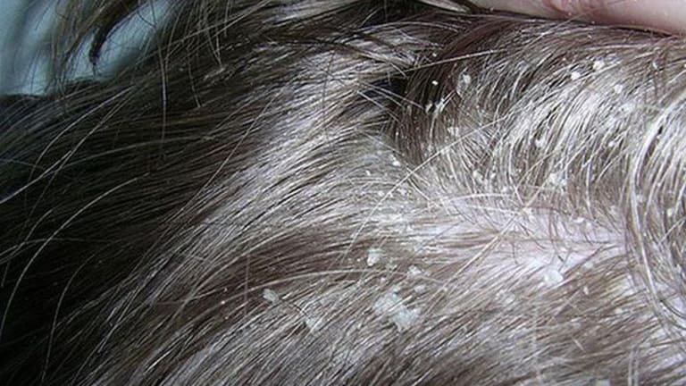 Nấm da đầu có lây không cần dựa vào nguyên nhân gây bệnh.