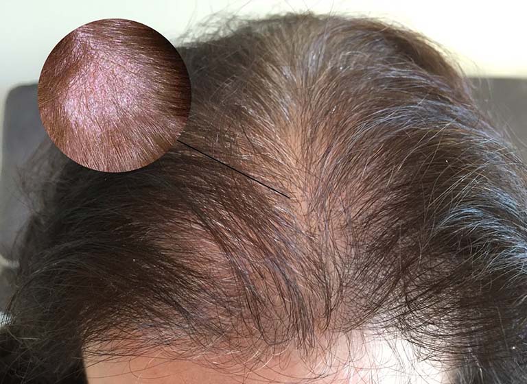 cách trị nấm da đầu gây rụng tóc