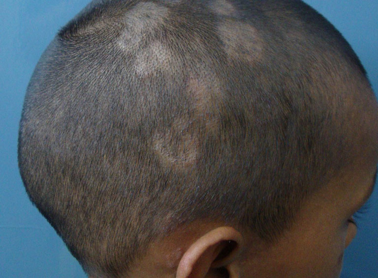 cách điều trị nấm da đầu cho trẻ em